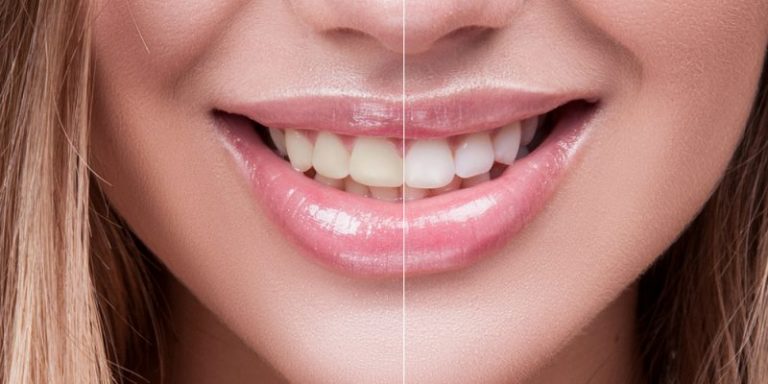 6 Best Teeth-Whitening Kits for Home Use: Best Teeth ...
